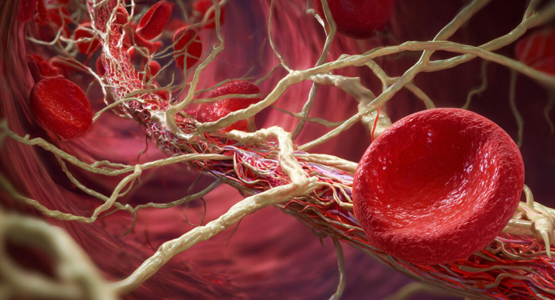 5 Natural Methods to Cleanse Arteries and Lower Plaque